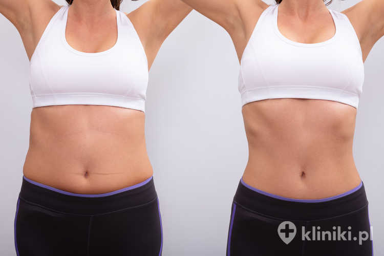 Efekty abdominoplastyki