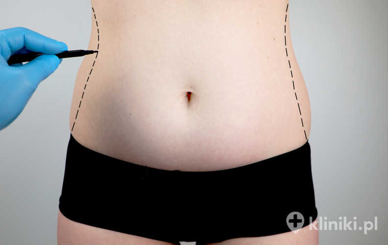 Lekarz obrysowuje miejsca obszary ciała do zabiegu liposukcji