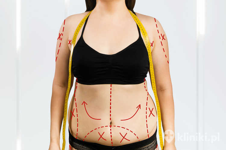 Liposukcja wibracyjna