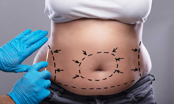 Przygotowywanie brzucha do zabiegu abdominoplastyki
