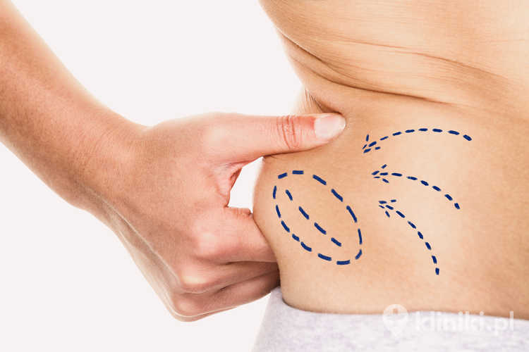 Usuwanie tzw. boczków metodą liposukcji Vaser Lipo HD