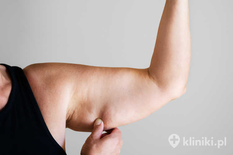 Kobieta z dużą ilością tkanki tłuszczowej na przedramionach - wskazania do liposukcji