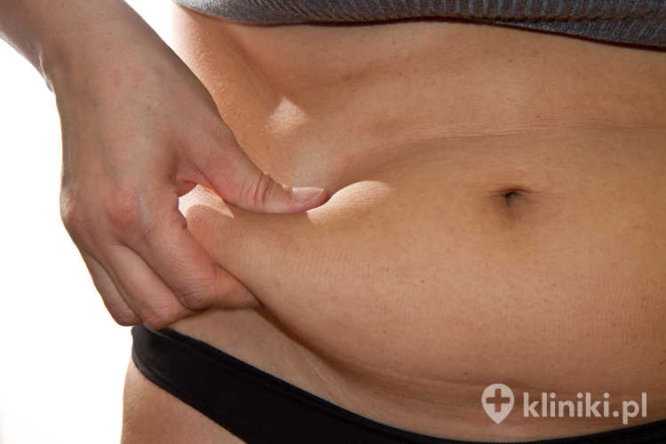 Liposukcja jako metoda odchudzania