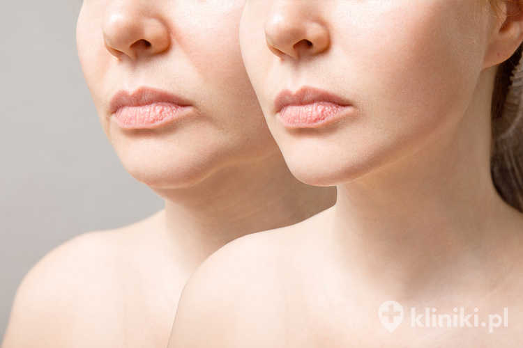 Modelowanie podbródka za pomocą liposukcji infradźwiękowej