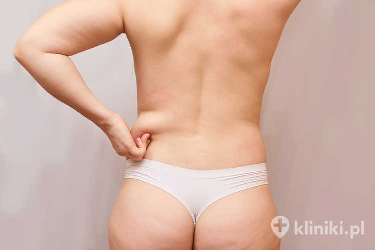 Zabieg liposukcji boczków metodą klasyczną