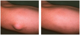 Dermatochirurgia przed i po zabiegu