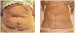 Liposukcja - odsysanie tłuszczu przed i po zabiegu