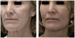 Modelowanie twarzy i ciała własnym tłuszczem przed i po zabiegu