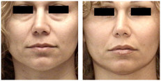 Modelowanie twarzy i ciała własnym tłuszczem przed i po zabiegu