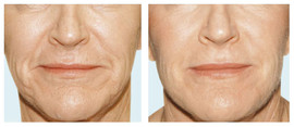 Modelowanie twarzy, wypełnienia zmarszczek preparatem Radiesse przed i po zabiegu