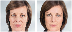 Modelowanie twarzy, wypełnienia zmarszczek preparatem Sculptra przed i po zabiegu