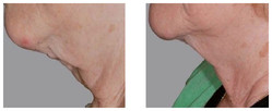 Protege - lifting szyi przed i po zabiegu