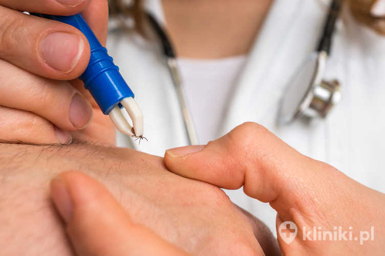 Lekarka usuwająca kleszcza pęsetą z ręki pacjenta.
