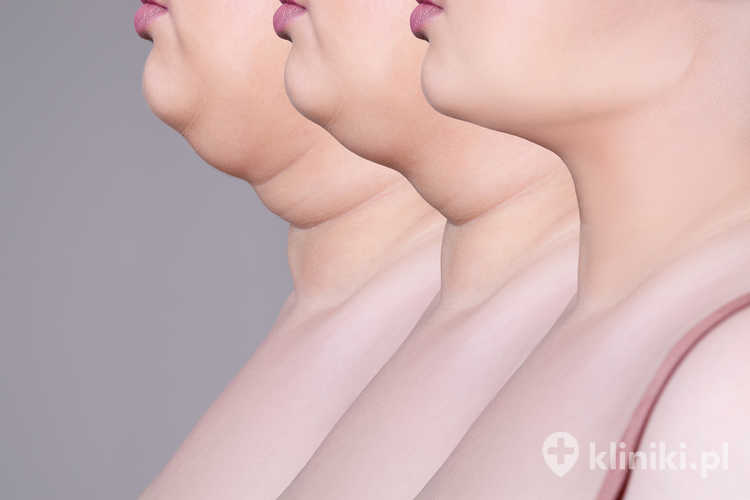 Liposukcja SmartLipo - efekty po zabiegu