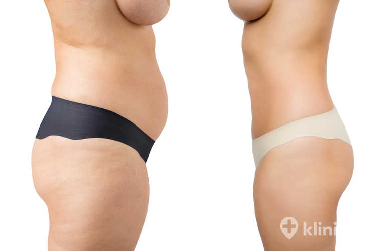 Liposukcja ultradźwiękowa Vaser Lipo - przed i po zabiegu