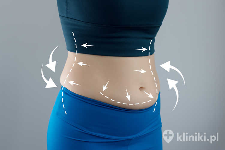 Efekty abdominoplastyki - wycięcie dużej ilości skóry
