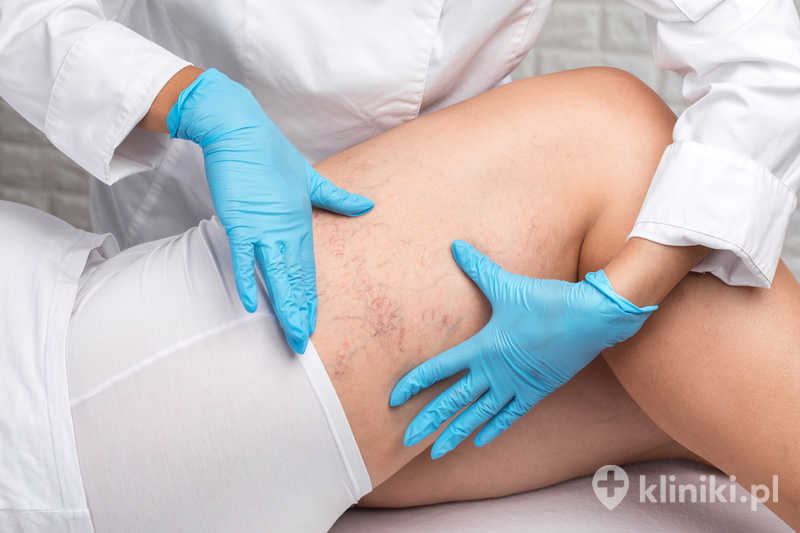 Lekarz pokazuje rozszerzenie małych naczyń krwionośnych skóry na nodze Lekarz pokazuje rozszerzenie małych naczyń krwionośnych skóry na nodze