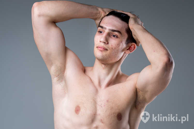 Podłożem wystąpienia ginekomastii u nastolatka może być nierównowaga hormonalna