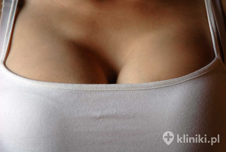 Zdjęcie kobiecych piersi po lipofillingu