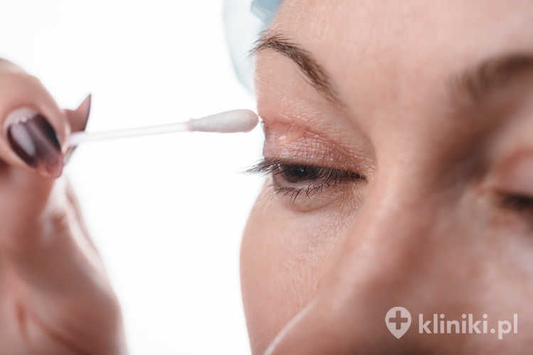 Blepharoplastyka powieki górne - operacja polegająca na usunięciu nadmiaru brzydkiej skóry powiek nad oczami