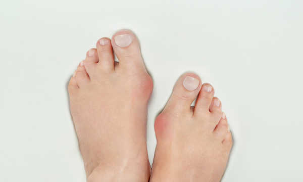 Leczenie operacyjne deformacji koślawej palucha "hallux valgus"