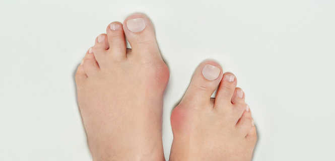 Leczenie operacyjne deformacji koślawej palucha "hallux valgus"