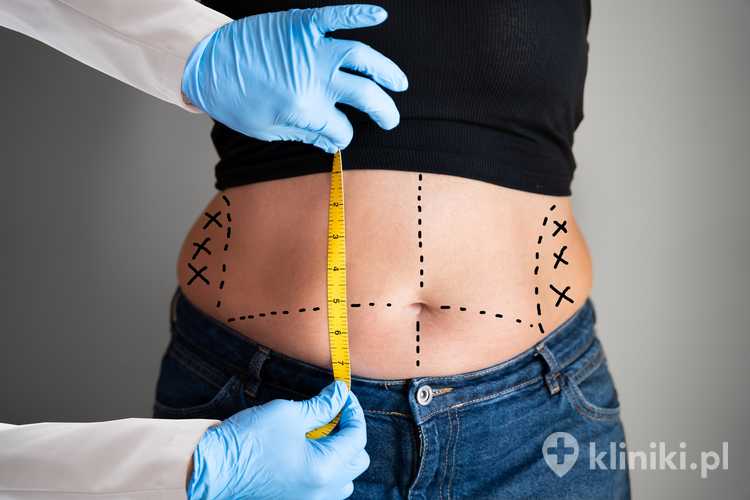 Lekarz mierzy pacjentce brzuch przed zabiegiem liposukcji