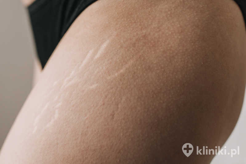 Dermapen likwiduje cellulit oraz rozstępy
