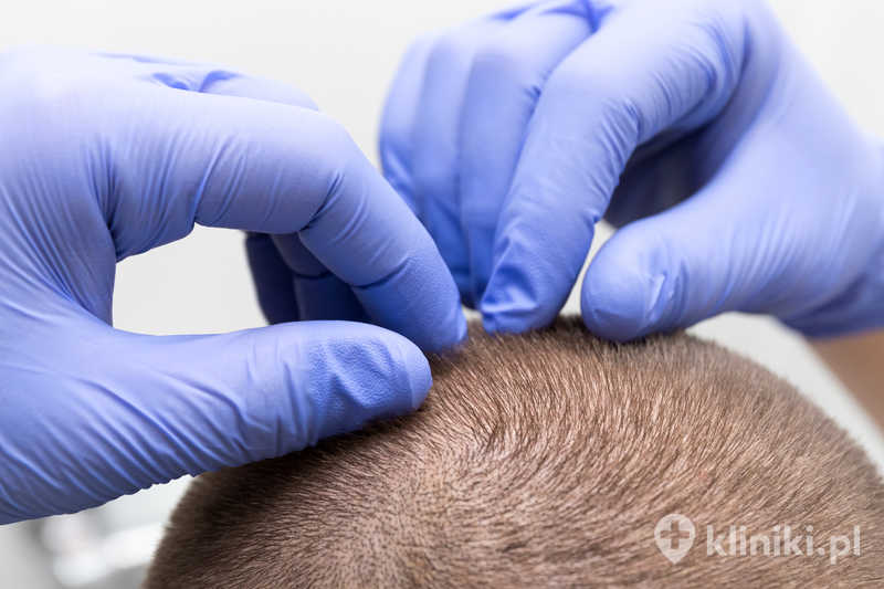 Dermatolog bada stan skóry głowy, mieszków włosowych, łysienie, problemy z wypadaniem włosów Dermatolog bada stan skóry głowy, mieszków włosowych, łysienie, problemy z wypadaniem włosów