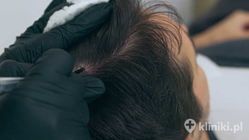 Jak działa mikropigmentacja HFS?
