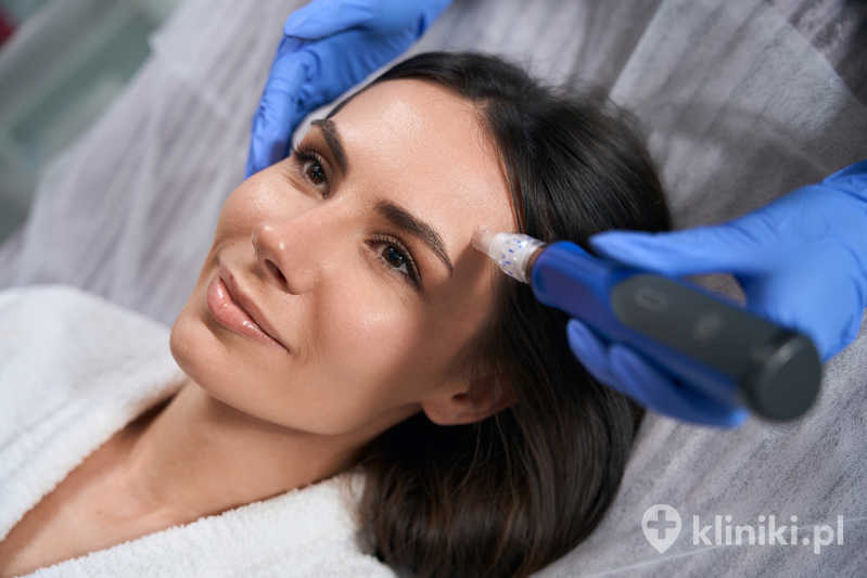 Leczenie trądziku za pomocą Dermapenu Leczenie trądziku za pomocą Dermapenu