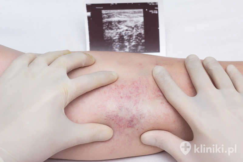 Lekarz w rękawiczkach bada żyły i nogi pacjenta pod kątem obecności zakrzepicy i żylaków kończyn dolnych Lekarz w rękawiczkach bada żyły i nogi pacjenta pod kątem obecności zakrzepicy i żylaków kończyn dolnych