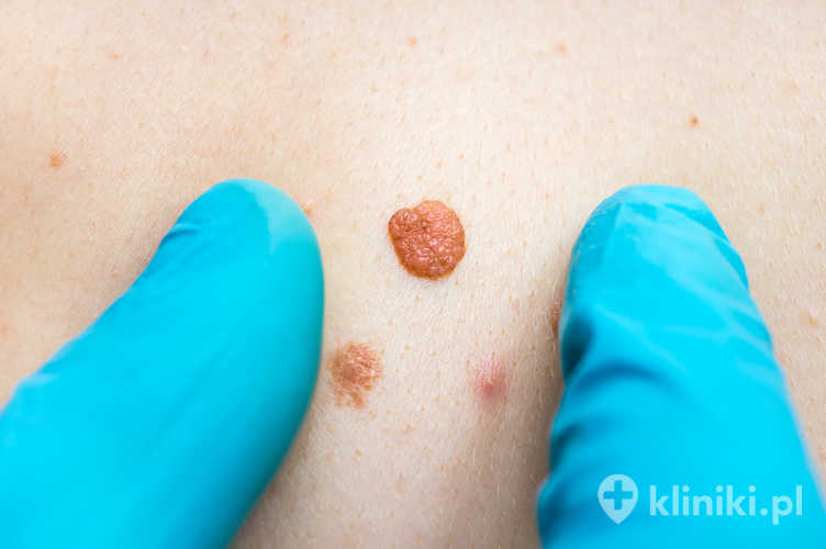 Woman with birthmark on her back, skin tags removal - cosmetic surgery