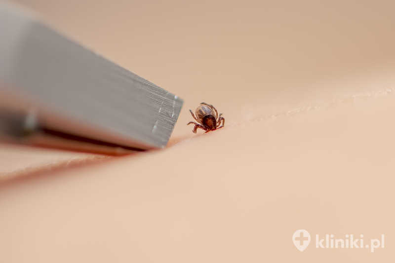 Wyciąganie kleszcza za pomocą pęsety Wyciąganie kleszcza za pomocą pęsety