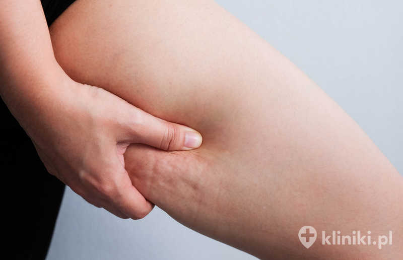 Dermapen wspomaga redukcję cellulitu na udach
