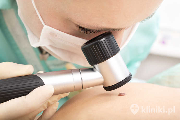 Dermatolog bada znamię za pomocą dermatoskopu