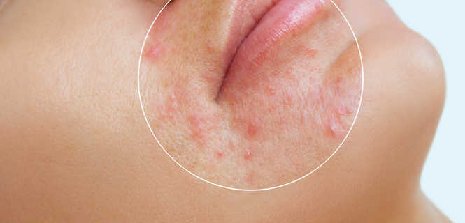 Blemiderm - zabieg Mesoestetic