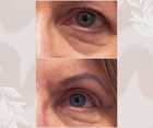Operacje plastyczne powiek przed i po zabiegu