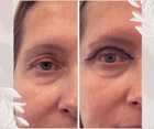 Operacje plastyczne powiek przed i po zabiegu