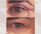 Operacje plastyczne powiek przed i po zabiegu