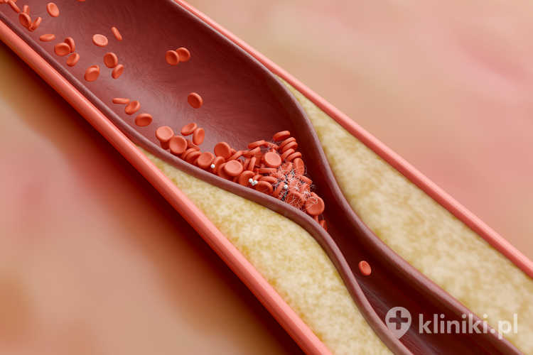 Wysoki poziom cholesterolu i zakrzepy krwi w tętnicach
