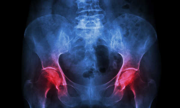 Bonviva - lek na osteoporozę
