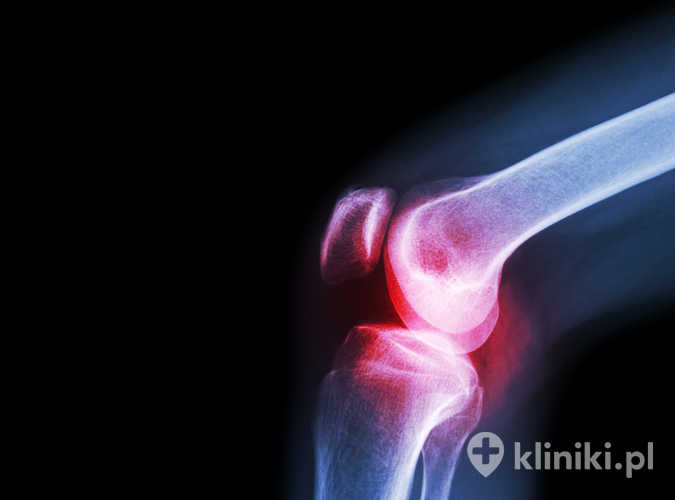 Terapia Orthokine®