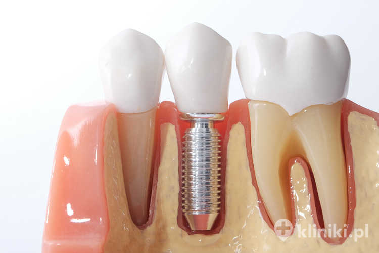 Rodzaje implantów