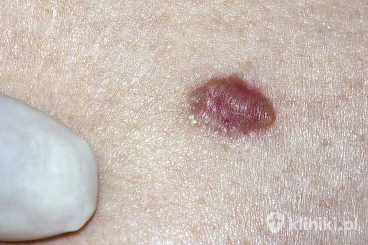Rak podstawnokomórkowy badany przez dermatologa