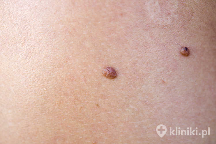 Rodzaje zmian skórnych diagnozowanych za pomocą mikroskopii konfokalnej