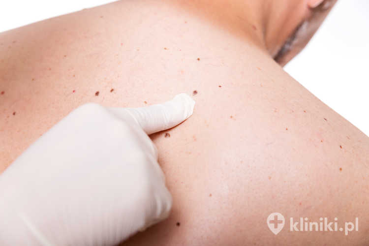 Rola mikroskopu konfokalnego w diagnostyce czerniaka