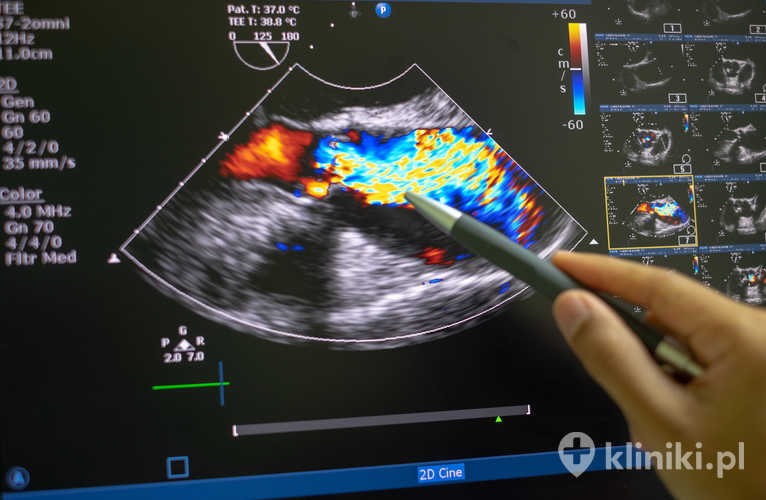 Przezklatkowa dwuwymiarowa echokardiografia z kolorowym dopplerem. Doppler zwężenia aorty