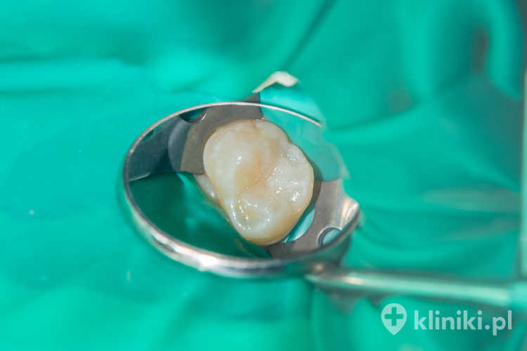 System SAF w endodoncji