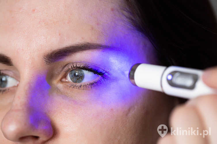 Laser frakcyjny w usuwaniu blizn